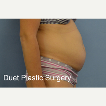 45-54 year old woman treated with Tummy Tuck before 3368743