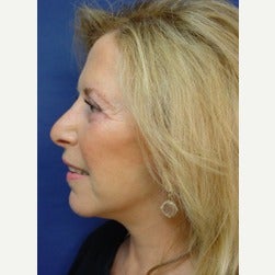55-64 year old woman treated with Fat Transfer after 2079253