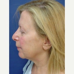 55-64 year old woman treated with Fat Transfer before 2079253