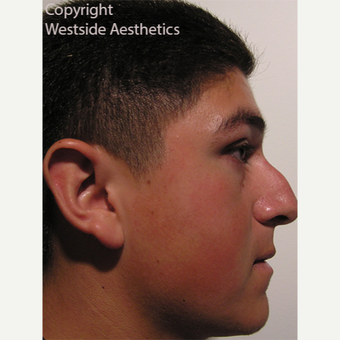 Non Surgical Nose Job Bumpy to Straight before 3004853