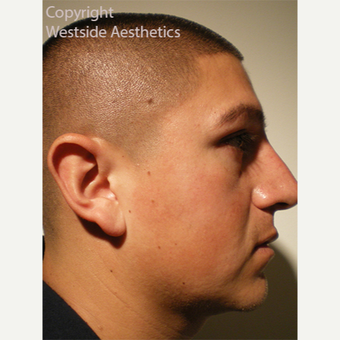 Non Surgical Nose Job Bumpy to Straight after 3004853
