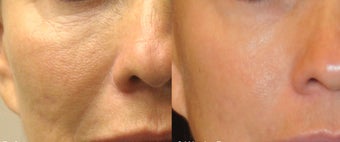 Sublative and ePrime for natural volume enhancement in cheeks before 1136366