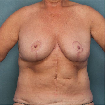 55-64 year old woman treated with Breast Reduction after 3442592