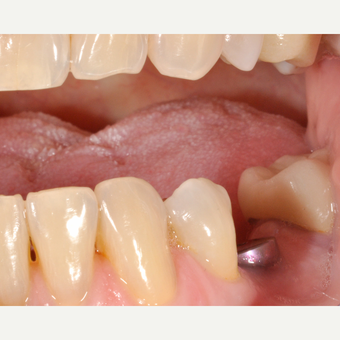 65-74 year old woman treated with Dental Implants before 3254027