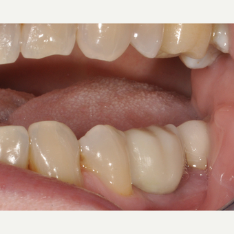 65-74 year old woman treated with Dental Implants after 3254027