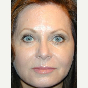 45-54 year old woman treated with Liquid Facelift and Natural appearing Lip Augmentation after 1936141