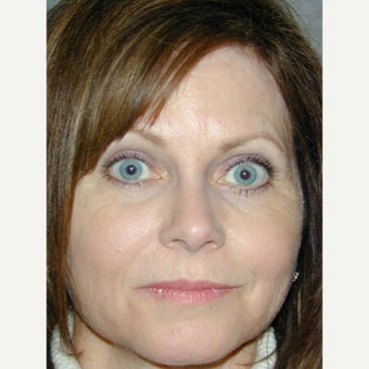 45-54 year old woman treated with Liquid Facelift and Natural appearing Lip Augmentation before 1936141