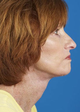 Lower Facelift & Necklift after 375295