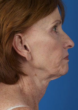 Lower Facelift & Necklift before 375295