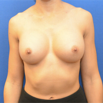 25-34 year old female treated with Breast Augmentation after 3731319