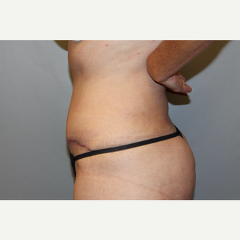 45-54 year old woman treated with Tummy Tuck after 3588254