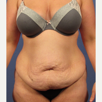 35-44 year old woman treated with Tummy Tuck before 3106712