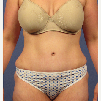 35-44 year old woman treated with Tummy Tuck after 3106712