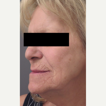 71 year old woman treated with Injectable Fillers for Facial Rejuventation before 3645960