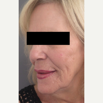 71 year old woman treated with Injectable Fillers for Facial Rejuventation after 3645960