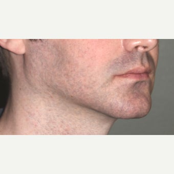 18-24 year old male treated with Chin Surgery (sliding genioplasty) and Jaw Angle Implants after 2352987