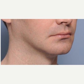 18-24 year old male treated with Chin Surgery (sliding genioplasty) and Jaw Angle Implants before 2352987