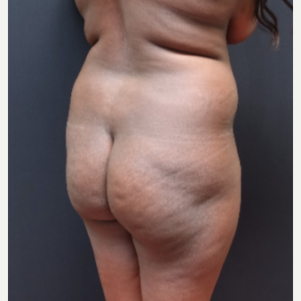 25-34 year old woman treated with Butt Lift before 3363871
