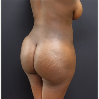 25-34 year old woman treated with Butt Lift after 3363871