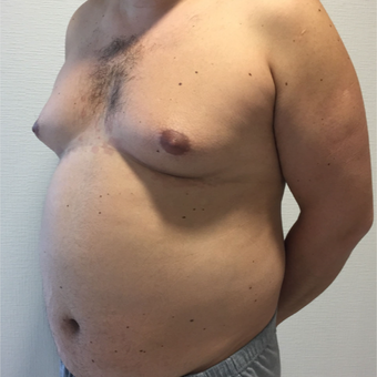 35-44 year old man treated with Vaser Liposuction before 3854230