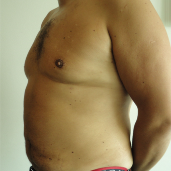 35-44 year old man treated with Vaser Liposuction after 3854230