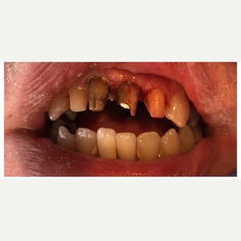 45-54 year old man treated with Porcelain Veneers before 3456903