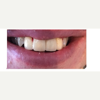 45-54 year old man treated with Porcelain Veneers after 3456903