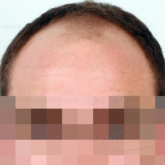 4089 FUT - Result after 6 months post-op before 3446130