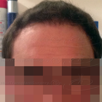 4089 FUT - Result after 6 months post-op after 3446130