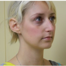18-24 year old woman treated with Rhinoplasty before 3371742