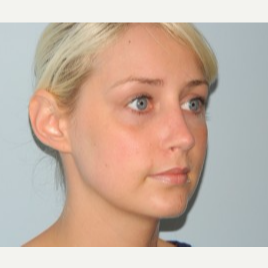 18-24 year old woman treated with Rhinoplasty after 3371742