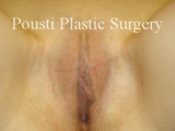Labial Reduction after 696352