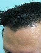 Nape Hair Transplant Patient after 195645