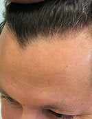 Nape Hair Transplant Patient before 195645