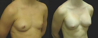 20 year old woman treated with Breast Augmentation before 2990288