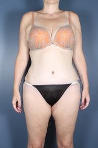 After Weight Loss, Tummy Tuck after 1394249