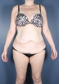 After Weight Loss, Tummy Tuck before 1394249
