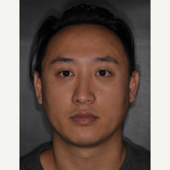 35-44 year old man treated with Rhinoplasty 8 months post-op after 3499903