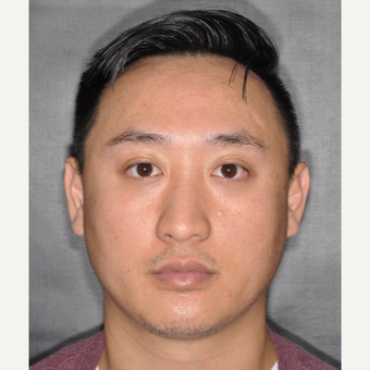 35-44 year old man treated with Rhinoplasty 8 months post-op before 3499903