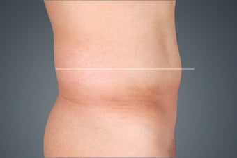 Non Surgical Fat Reduction after 476123
