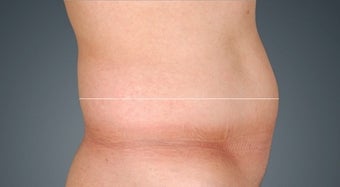 Non Surgical Fat Reduction before 476123