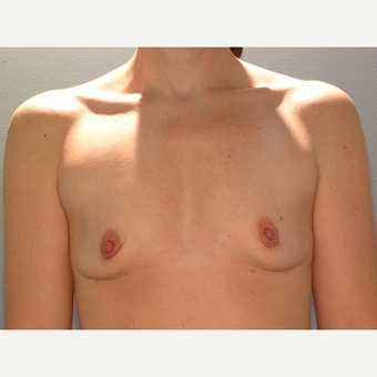 35 y/o Dual Plane Breast Augmentation before 3065871