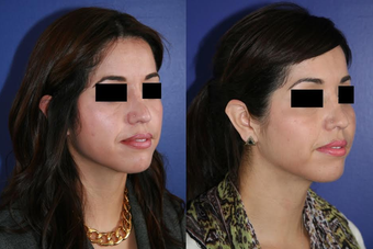 Cheek Augmentation before 1270384