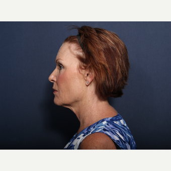 55-64 year old woman treated with Neck Lift (view 2 of 2) before 3709529