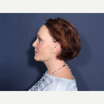 55-64 year old woman treated with Neck Lift (view 2 of 2) after 3709529