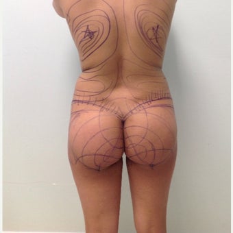 18-24 year old woman treated with Brazilian Butt Lift before 1918857