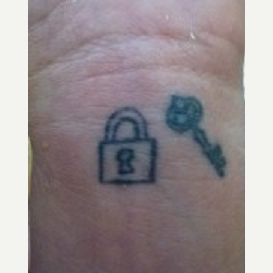 25-34 year old woman treated with Tattoo Removal before 3711701