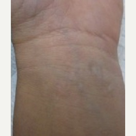 25-34 year old woman treated with Tattoo Removal after 3711701