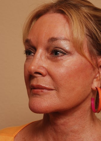 Refresher Facelift w/Neck Plication, Browllift, Fat Injections to Cheeks after 252900