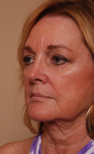 Refresher Facelift w/Neck Plication, Browllift, Fat Injections to Cheeks before 252900